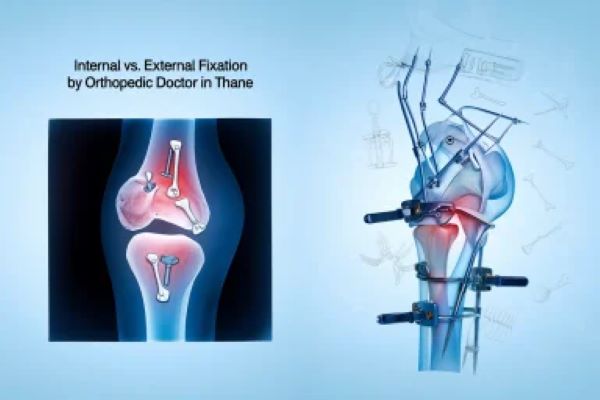 Internal vs. External Fixation by Orthopedic Doctor in Thane