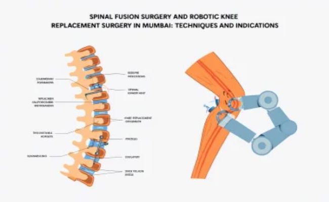  Spinal Fusion Surgery and Robotic Knee Replacement Surgery in Mumbai: Techniques and Indications