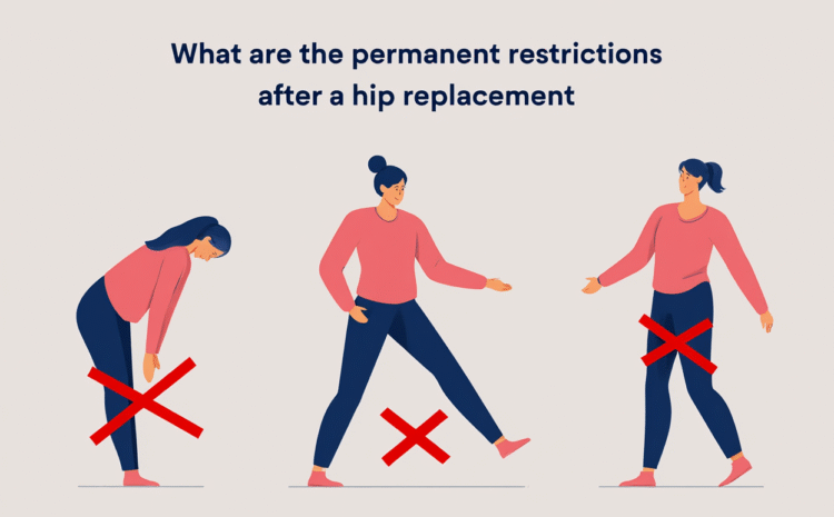  Permanent Restrictions After Hip Replacement Explained by the Best Orthopedic Surgeon in Thane